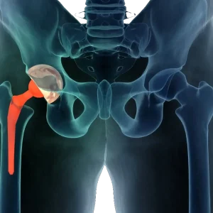 Anterior-Hip-Replacement.webp